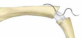 Step 10 Trial Insertion and Reduction (continued) Collateral Ligament Suture: Adequate soft tissue is usually found at the dorsal portion of the metacarpal bone in the vicinity of the accessory