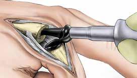 Insert the MCP Distal Component manually guiding implant into place using thumb pressure to seat into place. Gently use impactor for final positioning.