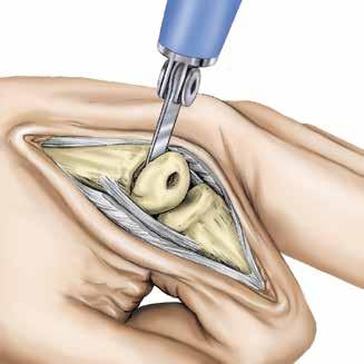 Step 3 Establishing Metacarpal Medullary Canal Alignment 3-1 Attach the Alignment Guide to the Alignment Awl. 3-1 Insert the Alignment Awl into the initial entry point.