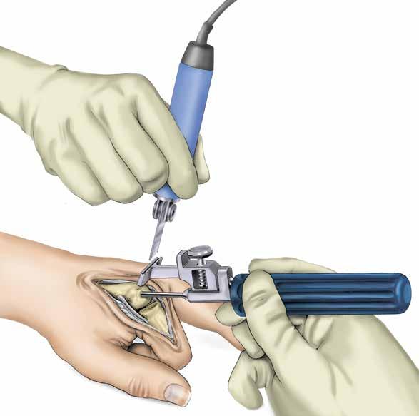 With the alignment awl guide mounted on the alignment awl it is possible to sight between the guide rod and the dorsal surface of the metacarpal.