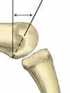 Step 4 Metacarpal Osteotomy 4-1 Remove Alignment Guide and place the Proximal Osteotomy Guide on the Awl. The Osteotomy Guide provides a 27.5 distal back cut. Advance the Osteotomy Guide 1.0-2.