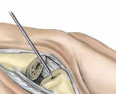 Step 5 Opening the Phalangeal Medullary Canal 5-1 Caution Flex the joint to avoid damage, by impingement of the K-wire or Starter Awl, to the dorsal edge of the