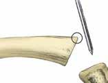Insert and advance the Alignment Awl into the proximal phalangeal medullary canal approximately 1/2 to 2/3 the length of the phalanx.