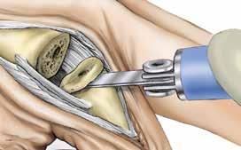 Step 7 Phalangeal Osteotomy 7-1 Remove Alignment Guide and place the Distal Osteotomy Guide on to the awl. The Osteotomy Guide provides a 5 distal back cut. Advance the Osteotomy Guide 0.5-1.