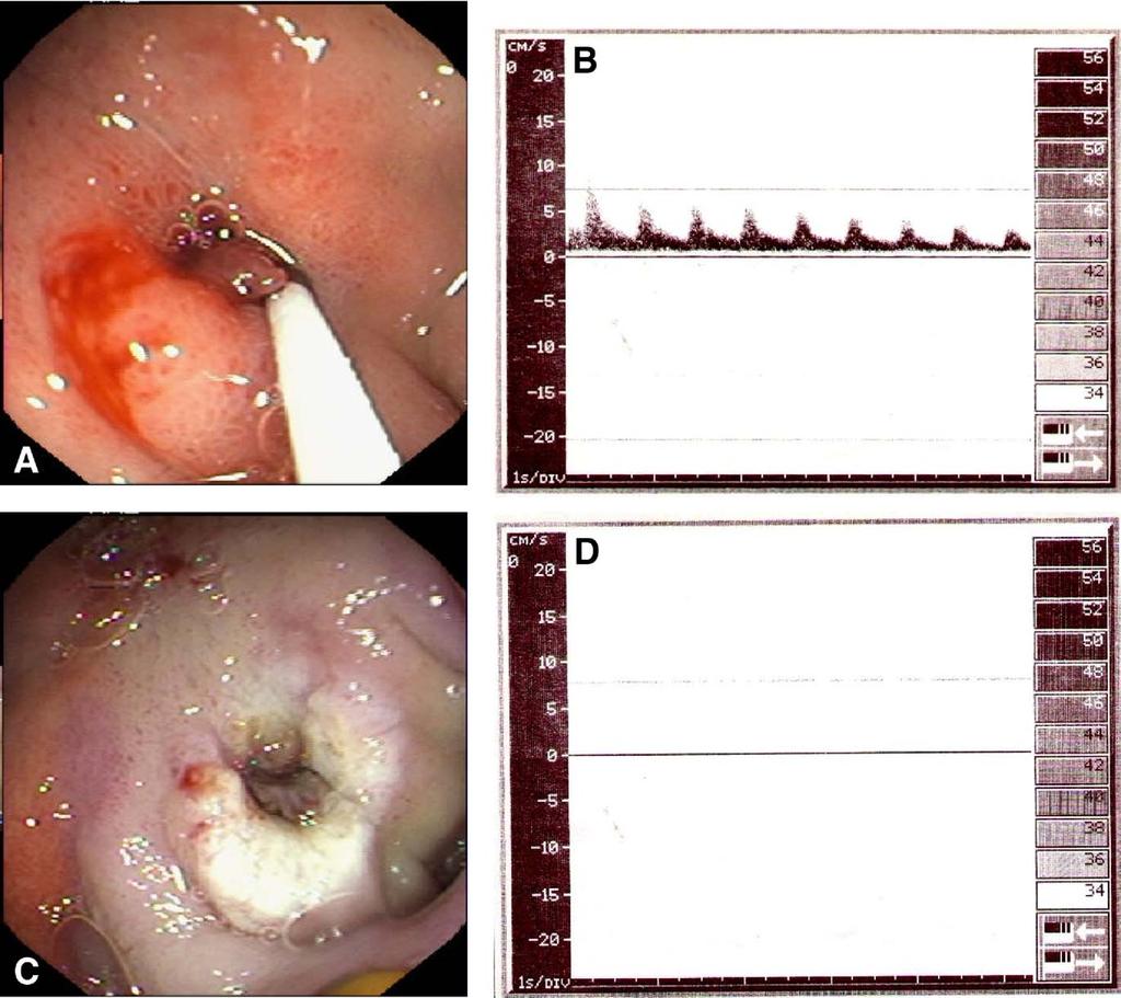 Figure 2. (A) Endoscopic image of a DopUS probe on a bleeding duodenal ulcer with a NBVV: Doppler-positive.