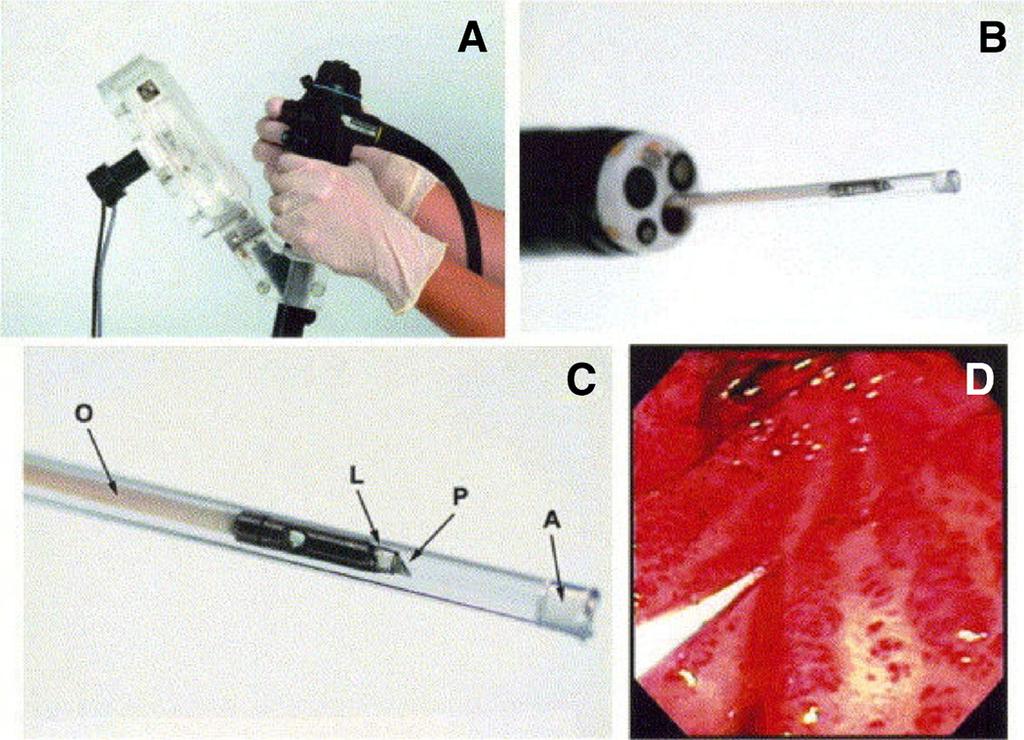 Figure 4. A, EDOCT scanner attached over the accessory port of the endoscope. B, Endoscope tip with catheter passed through the accessory channel.