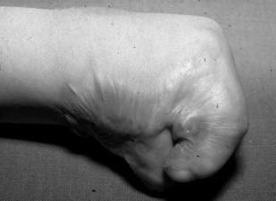 Figure 1-9: Excessive contracture in a burn of the hand [26] Figure