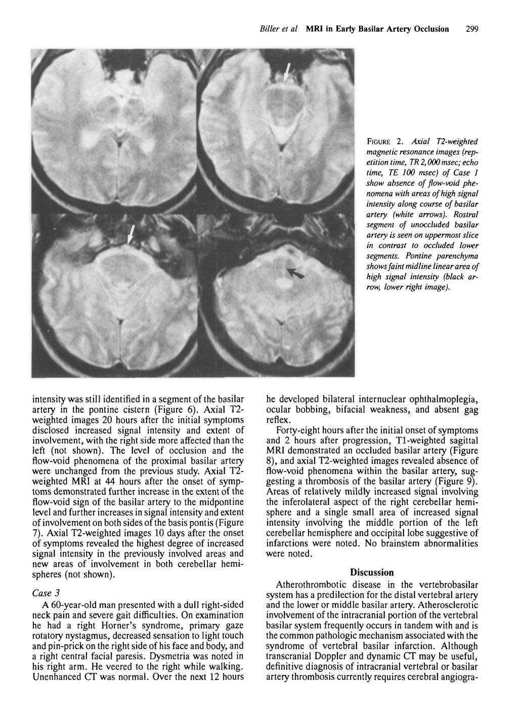 Biller et al MRI In Early Basilar Artery Occlusion 299 FIGURE 2.