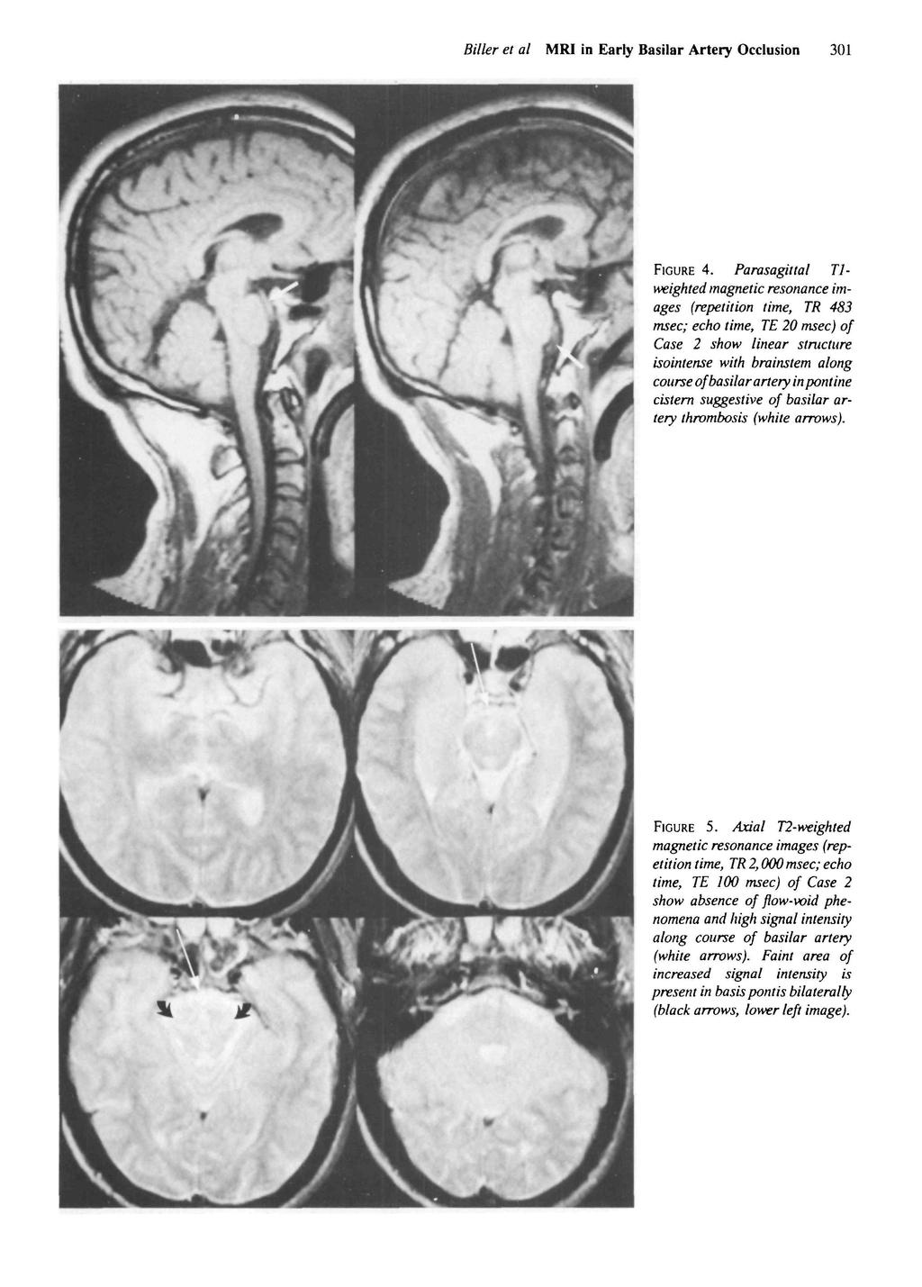 Biller et al MRI in Early Basilar Artery Occlusion 301 FIGURE 4.