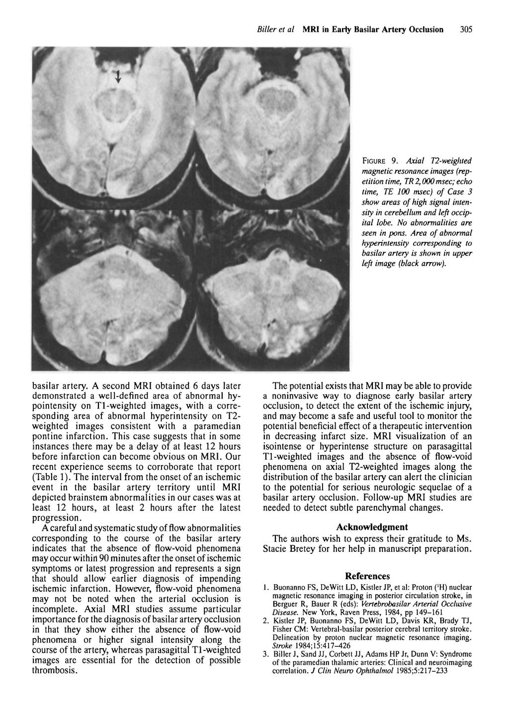 Biller et al MRI in Early Basilar Artery Occlusion FIGURE 9.
