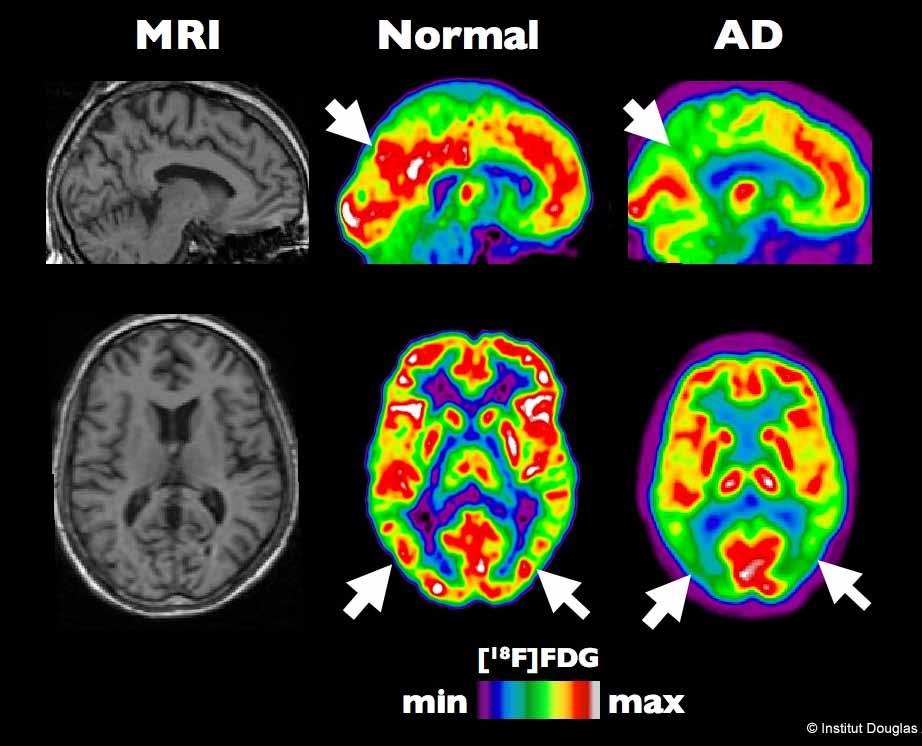 Alzheimer s Disease PET scan of a healthy brain compared to a brain at an early stage of
