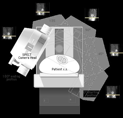 Single Photon-Emitted Computed Tomography (SPECT) Tomographic imaging technique using gamma rays.