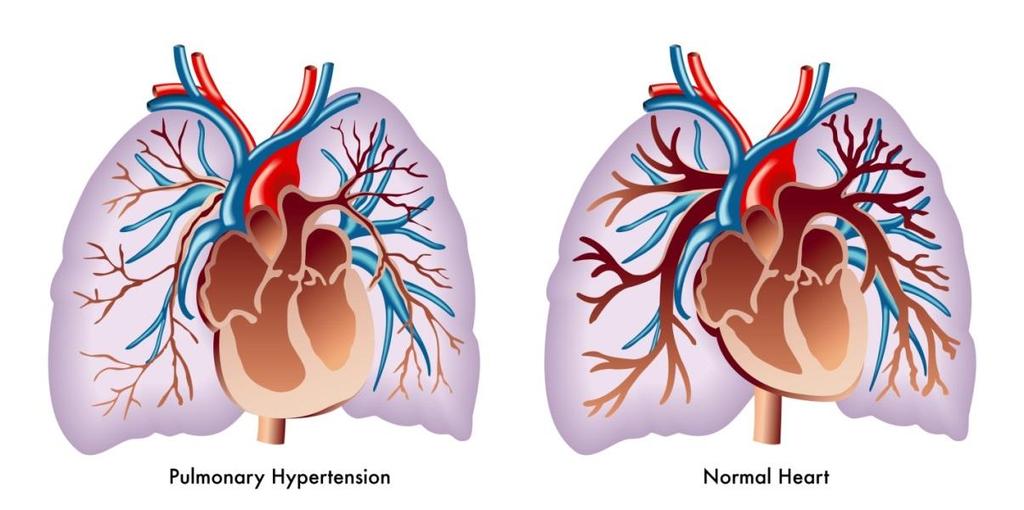 Chuvash polycythemia patients have different cardiovascular responses to hypoxia