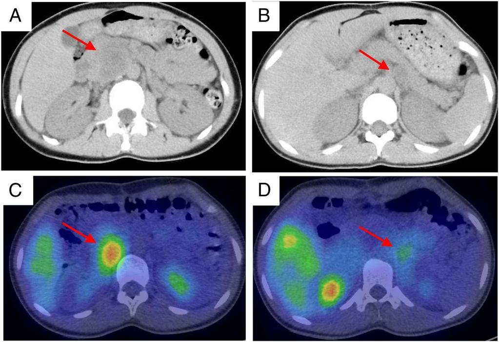 Paraganglioma have been reported in patients with HIF 2 a