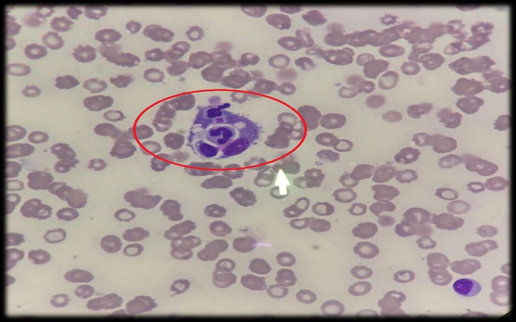 Hemophagocytosis: macrophages engulf host