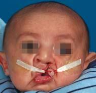 Grayson and Shetye A B C Figure 1: (A) Infant held in an inverted position during the impression process to prevent the tongue from falling back and to allow ß