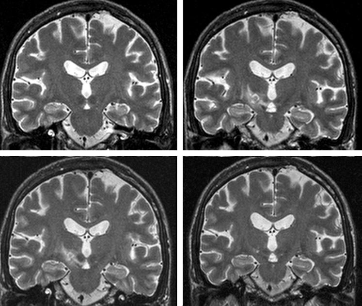 Figure 2 MRI showing the evolution of the image associated with a thermolytic lesion in the right subthalamic nucleus.