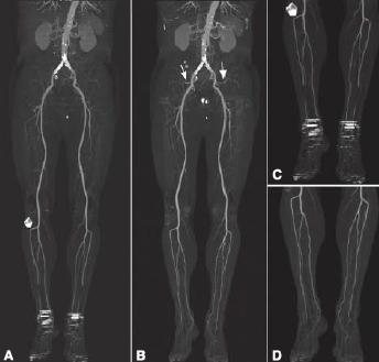 CTA Abdominal aortogram with runoff 6 Bone removal algorithm improves anatomic information, still with obstructive artifact (A&C)