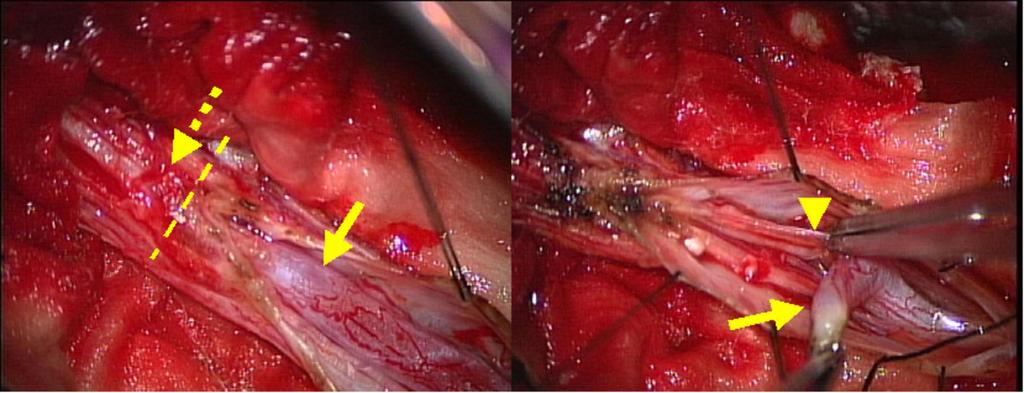 on the angiogram(two images on the right). Red fragmented lines on CTA indicate the dural cover. This means that the shuntig segment lies at the end of the dural sac or its dural continuation below.