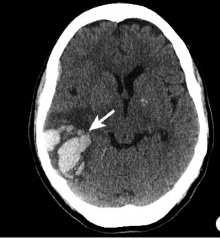 IPH-Cerebral amyloid angiopathy Cerebral