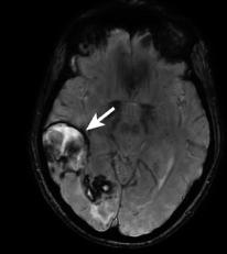 >60 Other areas of ICH Large cerebral IPH -DD