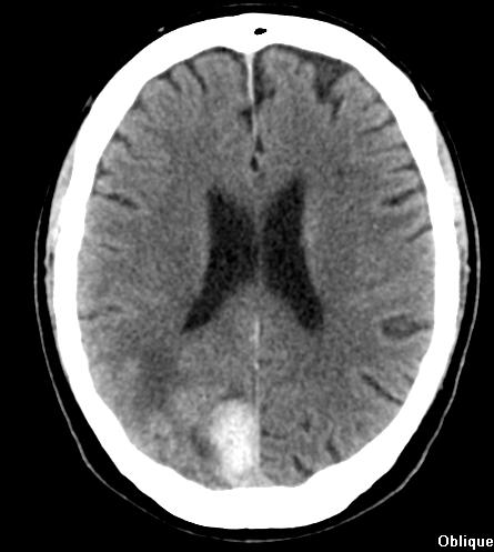 Mechanisms Hypertensive damage to blood vessels Rupture of ananeurysm Rupture of AVM Cerebral amyloid angiopathy
