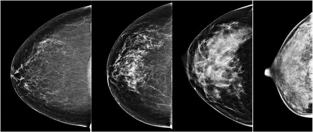 Breast Imaging Reporting and Data System (BI-RADS) a a b b c c d d Almost entirely fat Scattered fibroglandular densities Engmann et al, Jama Oncol, 2017 Heterogeneously dense Extremely dense