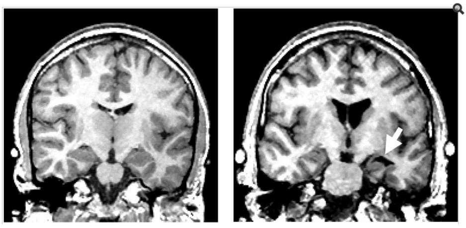 Enlarged ventricles Decreased white and gray matter volume Shenton et al.