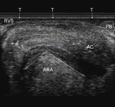 Using the 8848 transducer for the posterior compartment makes it possible to: Evaluate RVS (rectovaginal septum) integrity.