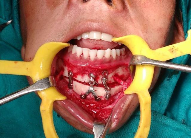 technique for surgical correction of facial asymmetry and unilateral mandibular deficiency. It not only allows lengthening of the deficient side, but also gives fullness to the sunken side.