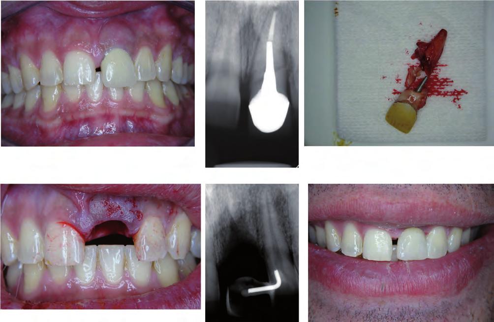 Three months later, the patient presented to the dental office. He still wore a temporary restoration. He followed my recommendations and participated well.