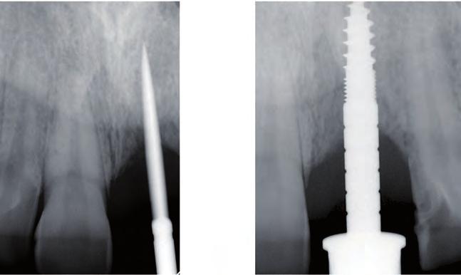 We were thinking about dental implant treatment, but the patient was afraid of further surgery in his front teeth site because he did not want to be reminded of his trauma in the