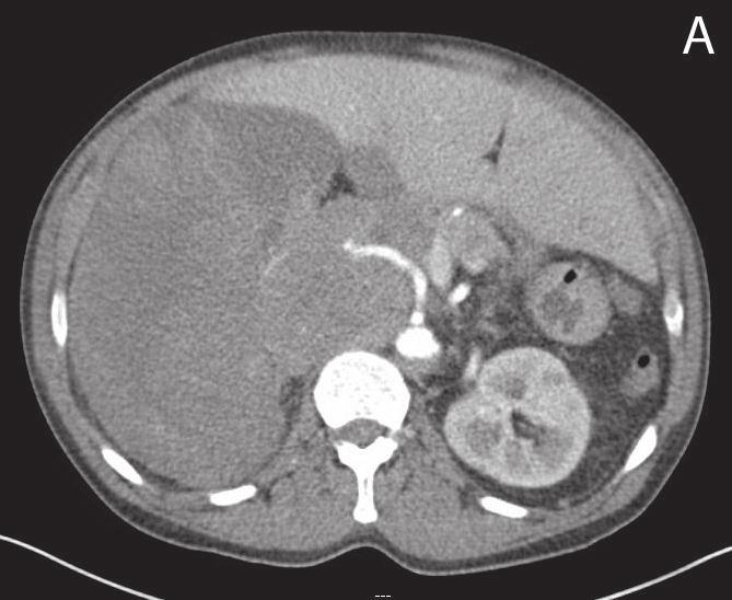 2 Case Reports in Urology Figure 1: Flow of contrast in the renal artery entering a large right-sided renal mass.