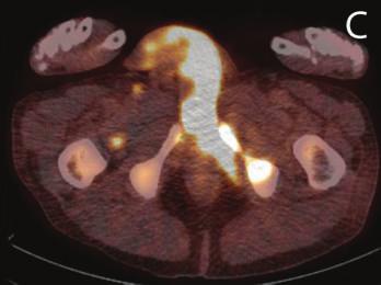 prostate that was inconsistent with malignancy.