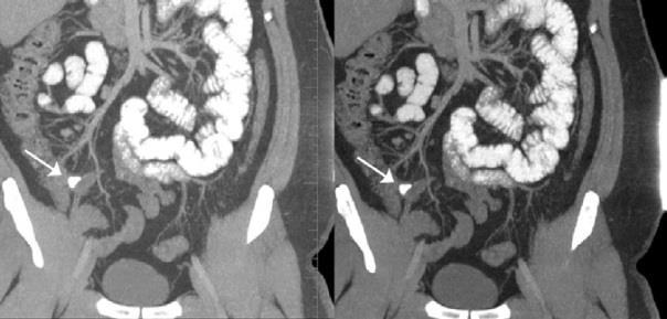 Figure 1: CT axial images of the lower abdomen, which show the appendicolith (arrows). This subject was in a noncooperative condition.