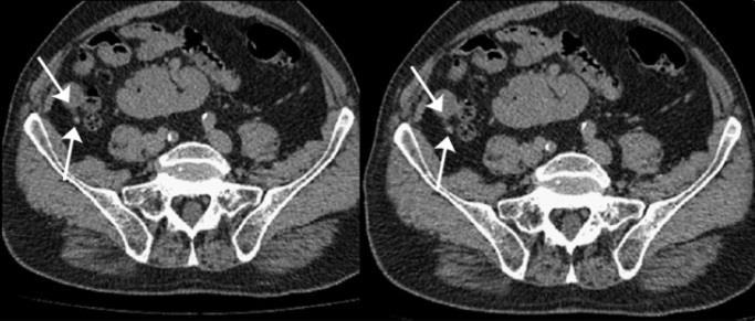were observed in the x-ray images. A severely inflamed appendix (dilated at 9.0 x 2.5) was revealed by the CT scan as shown in Figures 3 and 4.