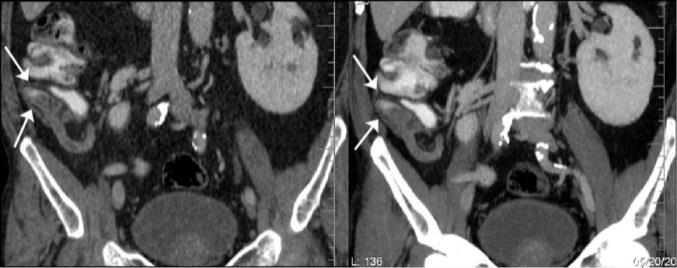 This scan showed that there were small appendicoliths in the appendix, which were not controlled. Figure 3: CT axial images of the lower abdomen, which show the appendicolith (arrows).