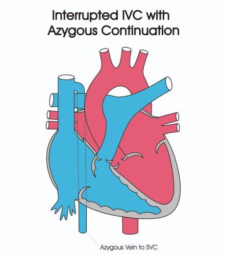 In interrupted IVC, (s. solitus, LA isom) hepatic segment is absent Azygos vein continuation to SVC.