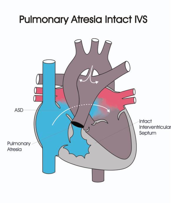 controlled pulmonary blood flow - Secure a