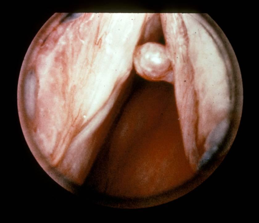Vocal Cord Nodules Reactive nodules, also called polyps. Heavy smokers or in individuals who strain their vocal cords (singers' nodules).
