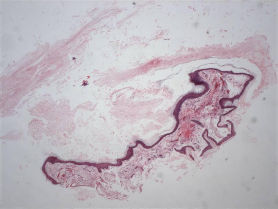 Cholesteatoma Cystic or open mass of keratin squames