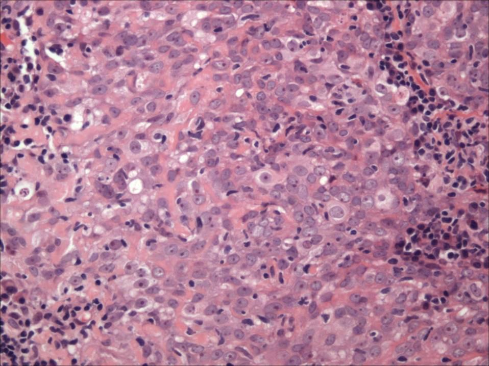 Nasopharyngeal Carcinoma Arises from lateral wall of nasopharynx,
