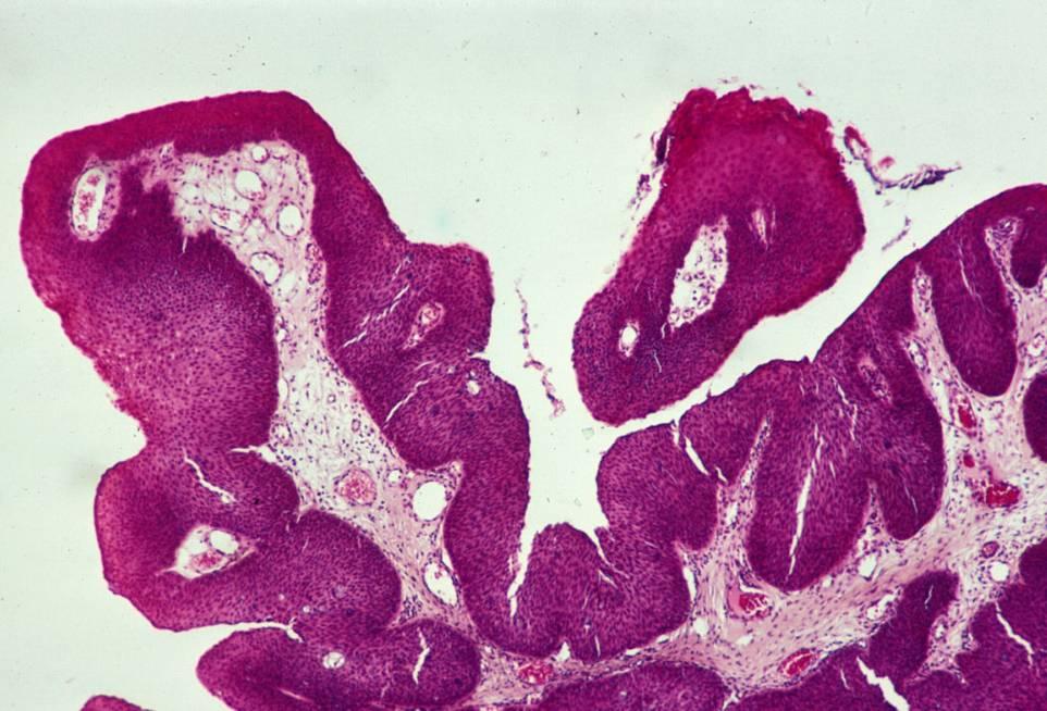 Laryngeal squamous cell carcinoma Glottic, supraglottic and infraglottic Smoking