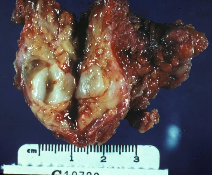 Pleomorphic Adenoma Most common salivary gland tumor: 60% of all salivary neoplasms Mean