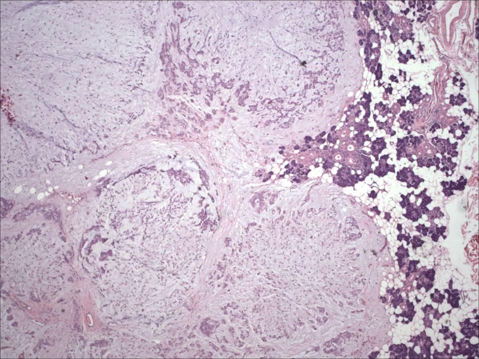 Pleomorphic Adenoma Variably encapsulated: irregular in thickness, absent in
