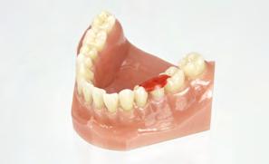 STEP-BY-STEP INSTRUCTIONS FOR PROSTHETIC PROCEDURES ILLUSTRATED USING A STRAUMANN BONE LEVEL IMPLANT (RC) The final restoration is fixed on the master cast and delivered to the dental practice.