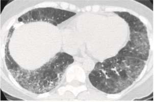 Diagnosis - HRCT High-resolution computed tomography (HRCT) of the lung provides detailed visualization of the lung parenchyma. More sensitive than chest X ray and PFT.
