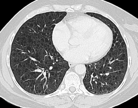 Lymphocytic Interstitial Pneumonia CT findings are nonspecific but include mixed alveolar interstitial infiltrates and thin-walled cysts.
