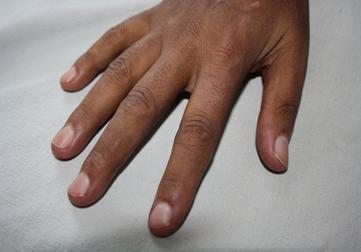 5, Globulin- 5.5, TSH-5.48 and CPK- 3600. In view of the features suggestive of inflammatory myopathy, sclerodactyly, other skin changes, very high ESR and CRP.