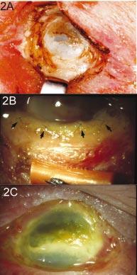 Failure of amniotic membrane transplantation in the treatment of acute ocular burns 1067 graft and lateral tarsorrhaphy was performed to encourage healing of the epithelial defect (Fig 2C).